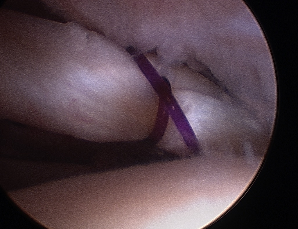 Arthroscopy Secured Biceps Tendon